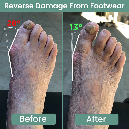 3D Bunion Splint Corrector Device