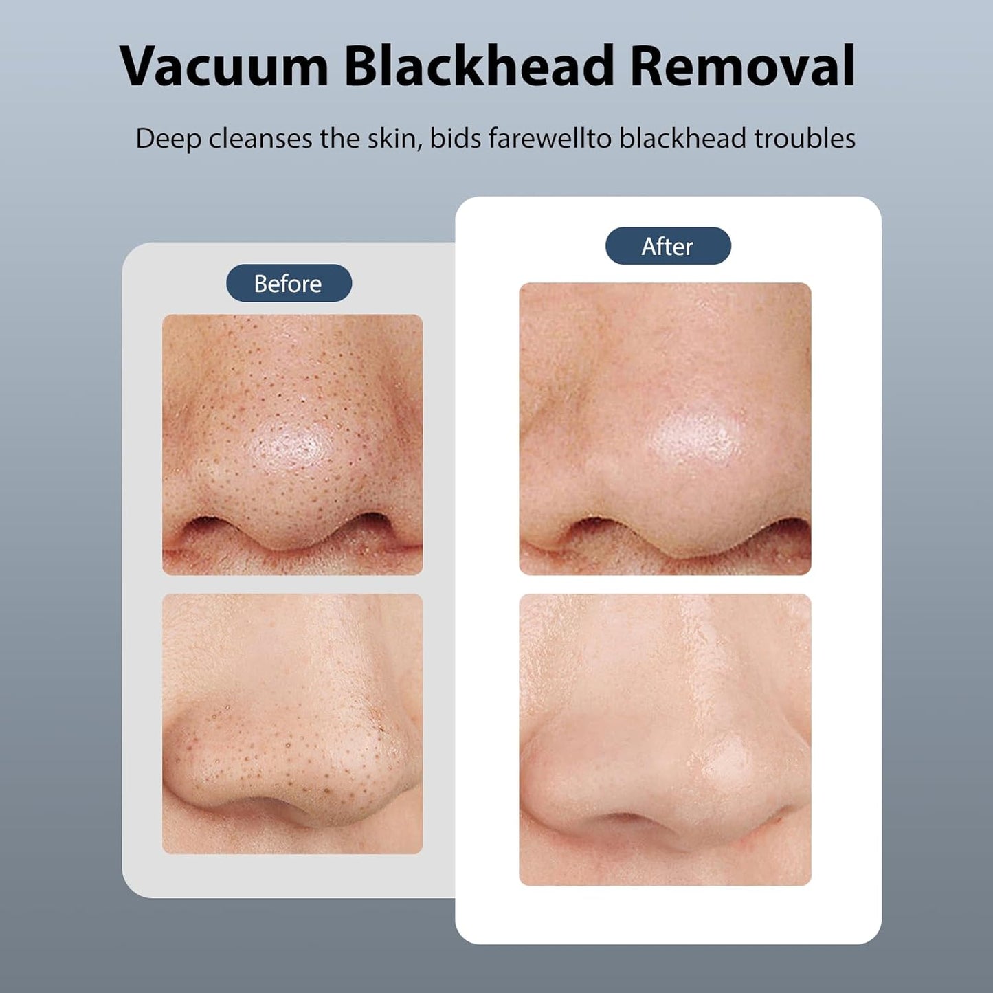 Hydra Facial Blackhead Removal Kit